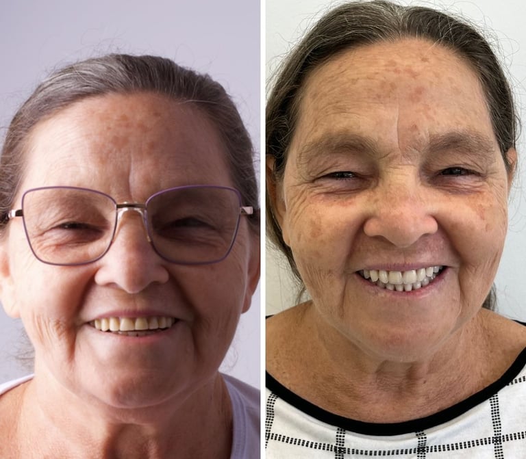 Antes e depois de tratamento com prótese protocolo