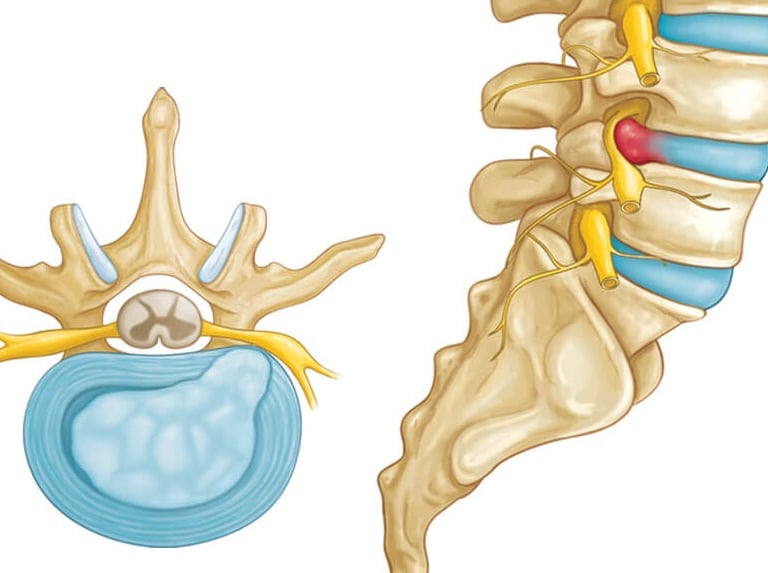 hernia de disco, hernia discal, dor na coluna, ciático