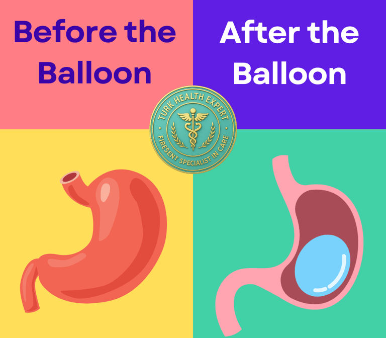 the estomac before and after gastric Balloon