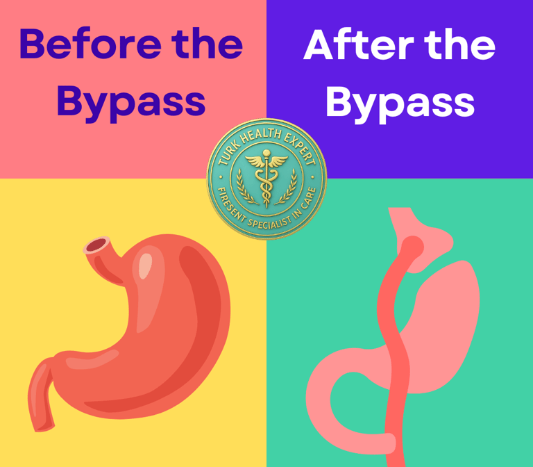 the estomac before and after gastric bypass