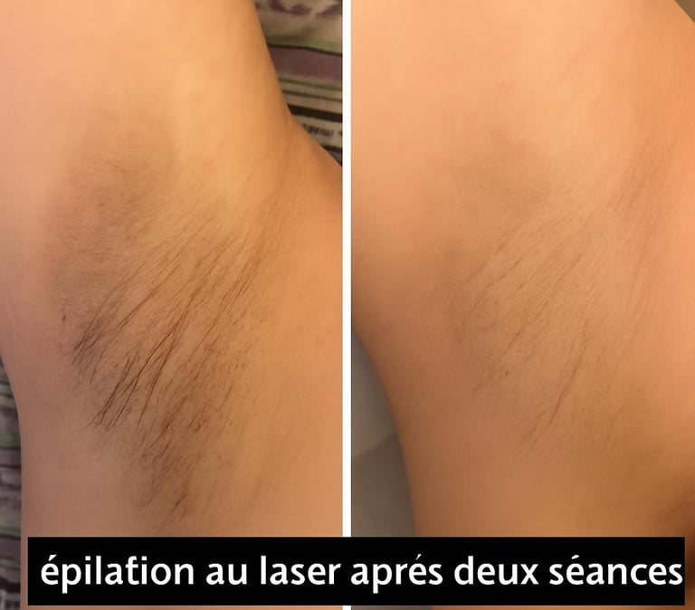 épilation laser avant / après aisselles