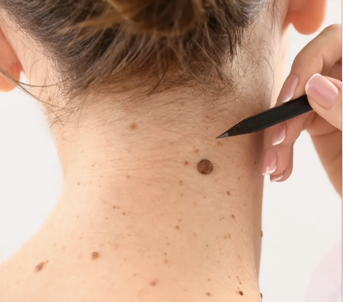 eliminación de verrugas 