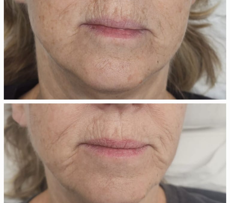 Before and after ResurFX treatment at Ariana Esthetic Edmonton