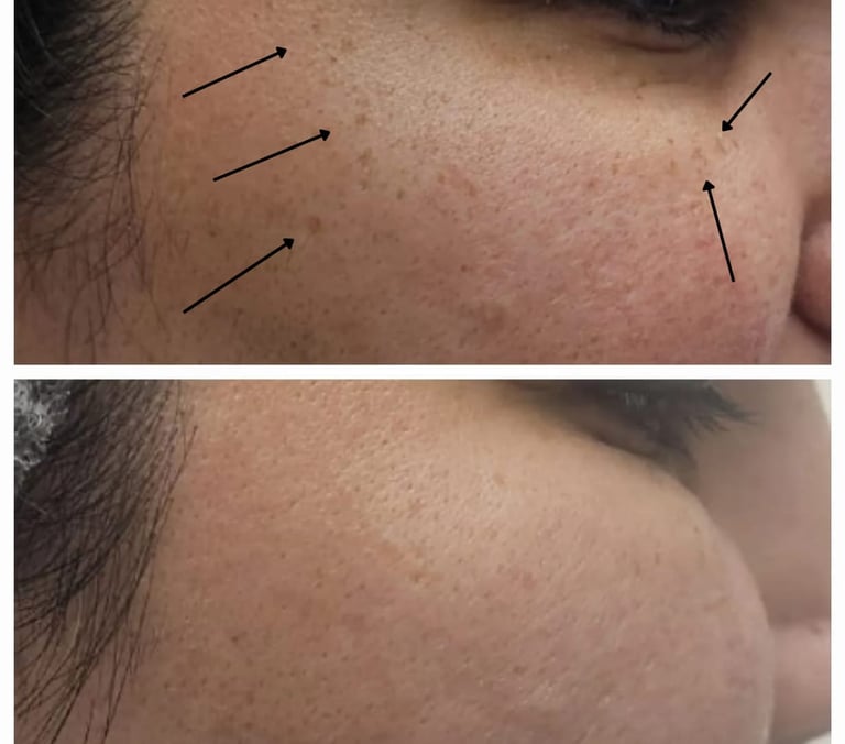 Freckle treatment at Ariana Esthetic Clinic Edmonton, using advanced technology.