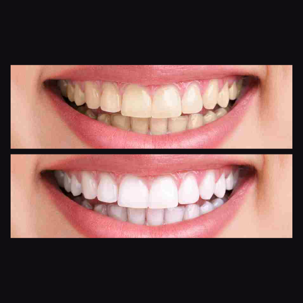 blanquemaiento dental