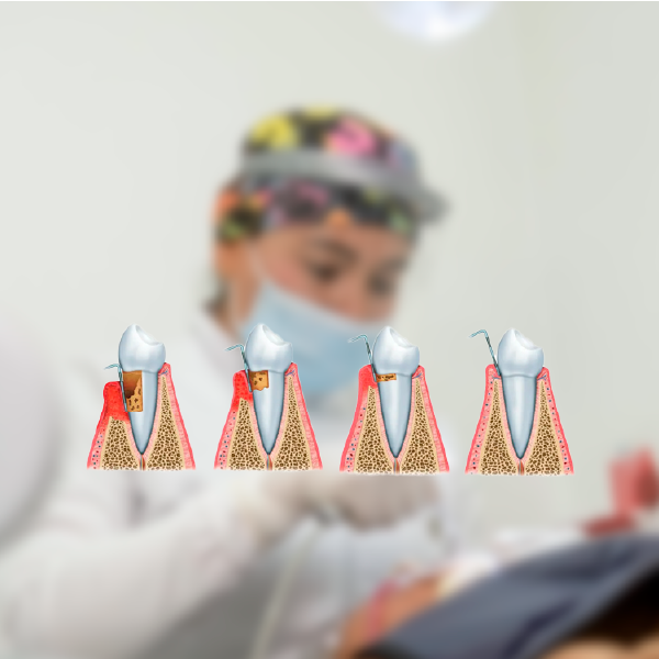 Periodoncia