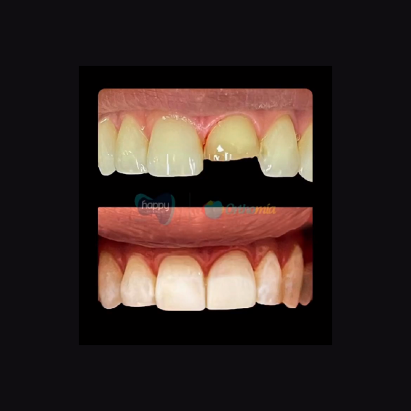 Rehabilitación oral