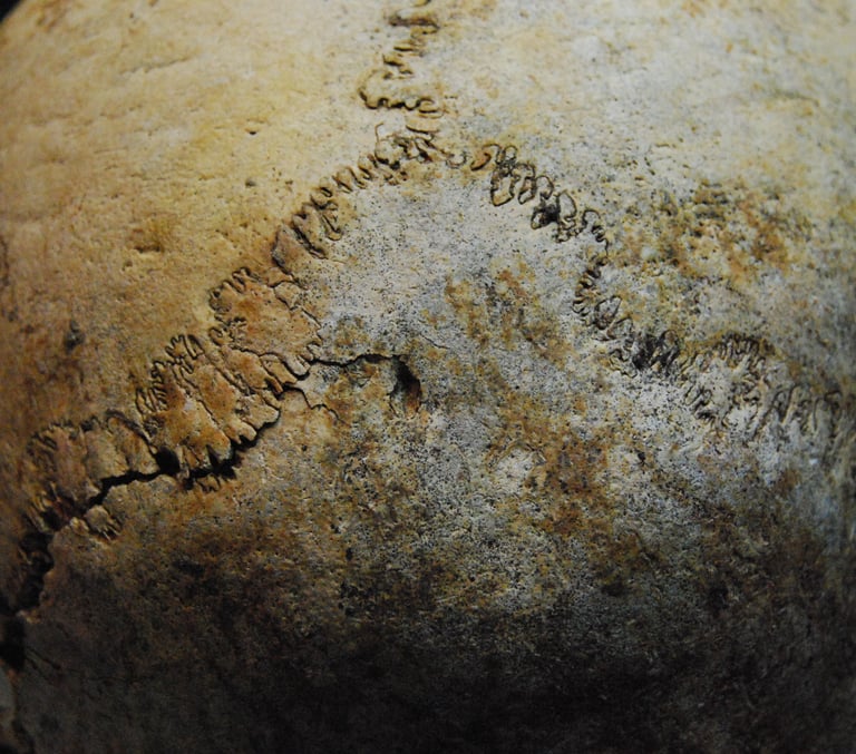 Wormian bones in the lambdoid suture