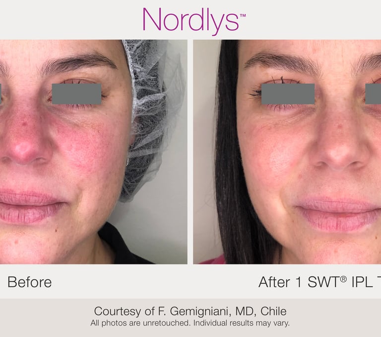 Redness & Vascular (Rosacea) Treatment in Hamilton, Ontario