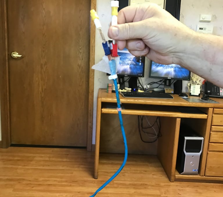 Removal of my Heart Port