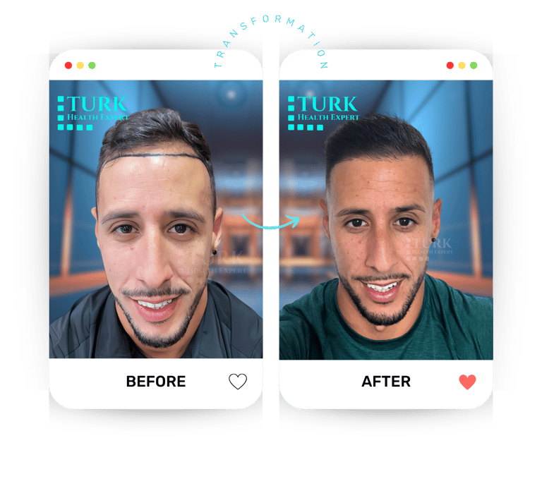 before after hair transplant
