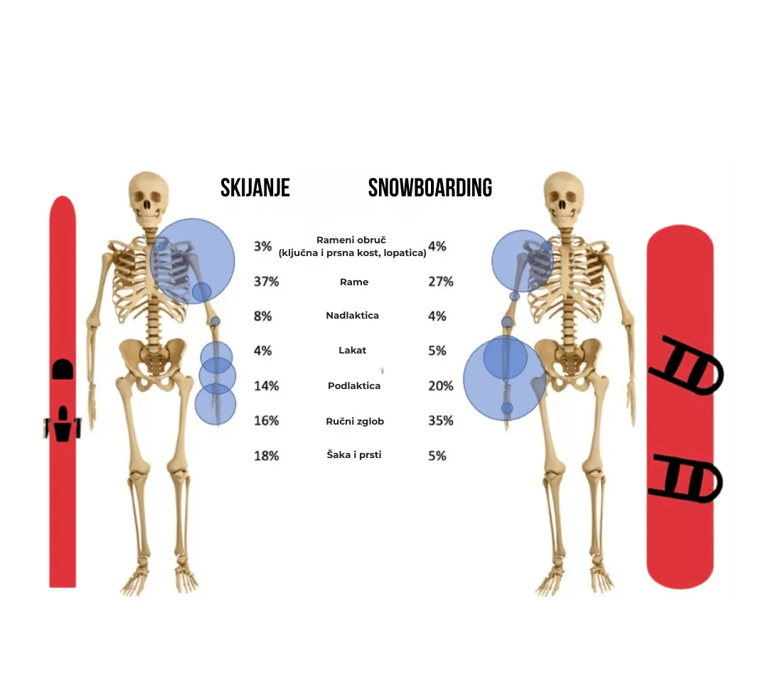 Je li opasnije skijanje ili snowboarding?