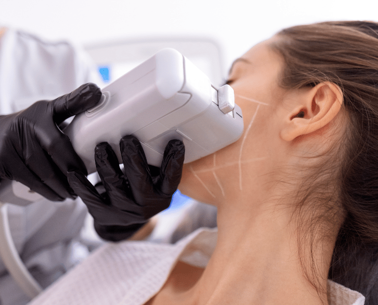 sideview of woman's cheek getting HIFU skin tightening treatment with hand held machine