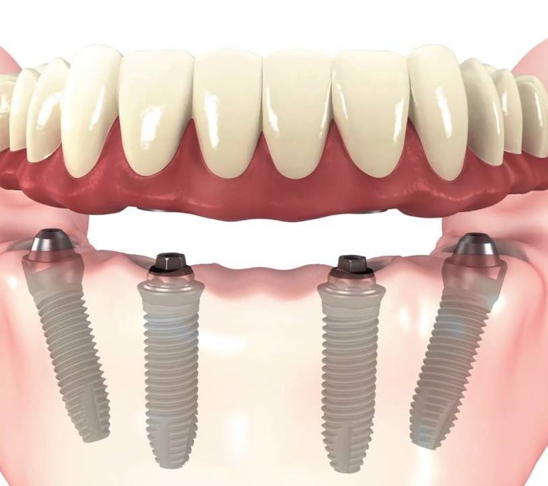 Get fix teeth with Dental Implants