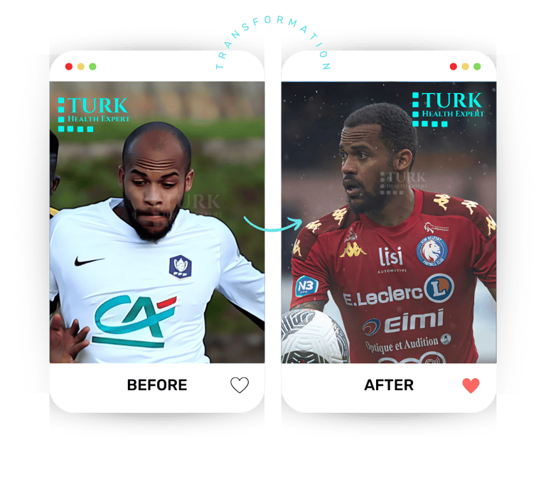 ligue player hair transplant