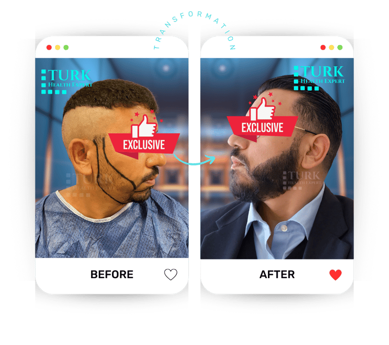 Celebrities Beard Transplant