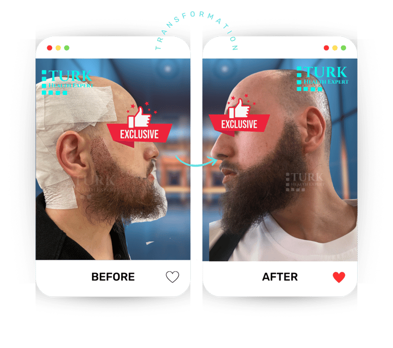 Celebrities beard Transplant