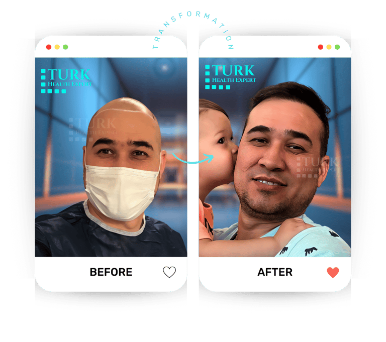 Celebrities Hair Transplant