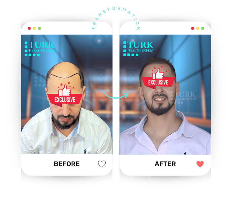 Celebrities Hair Transplant