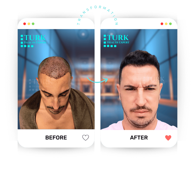 Celebrities Hair Transplant
