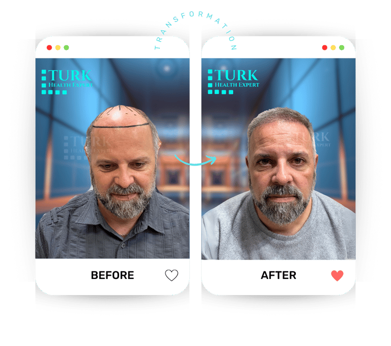 Celebrities Hair Transplant