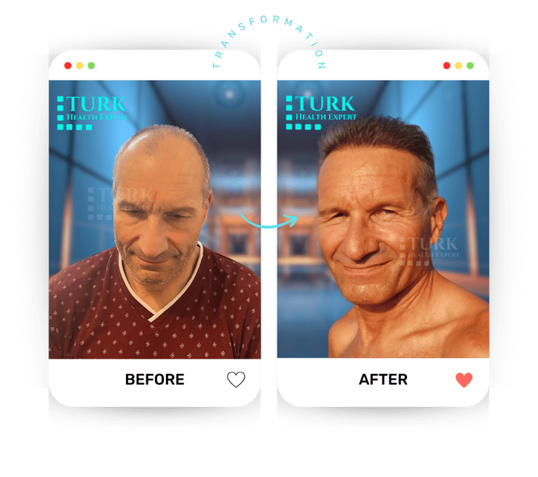 Celebrities Hair Transplant