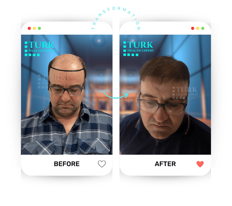 Celebrities Hair Transplant