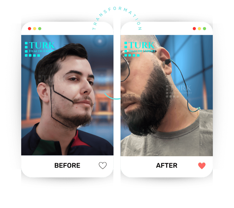 Celebrities beard Transplant