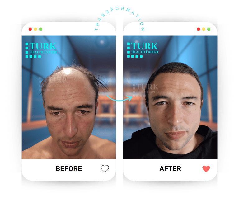 Celebrities Hair Transplant