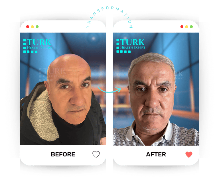 Celebrities Hair Transplant