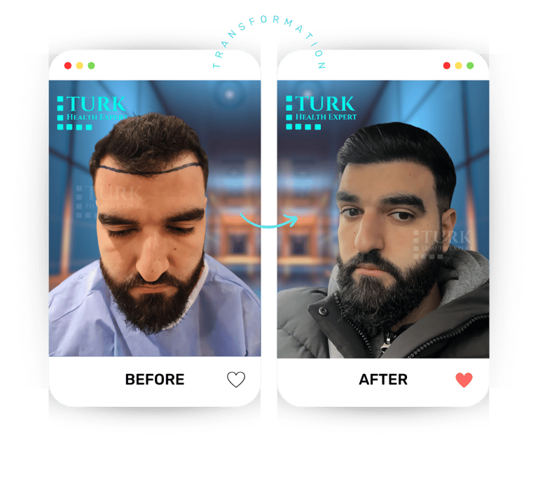 Celebrities Hair Transplant