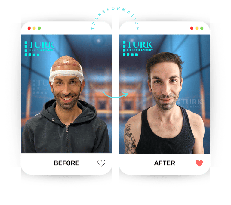 Celebrities Hair Transplant