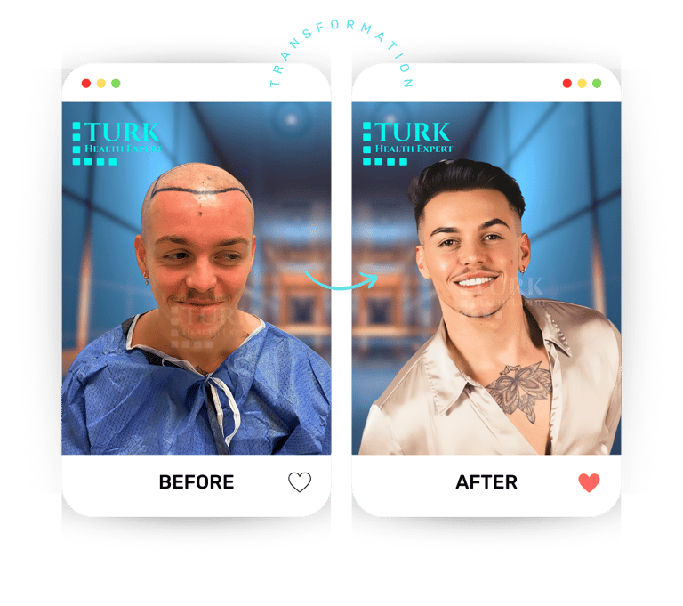 before after hair transplantation