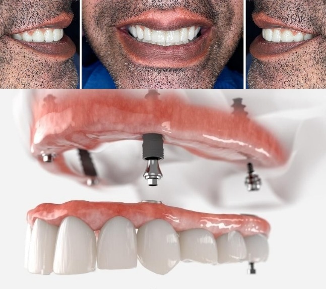 Patient with the All on 4 procedure, final stage