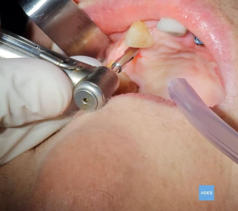Implante dental