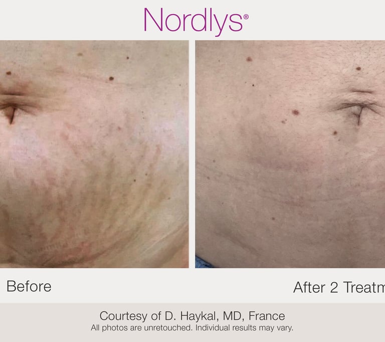 Scar & Stretch Mark Treatment in Hamilton, Ontario