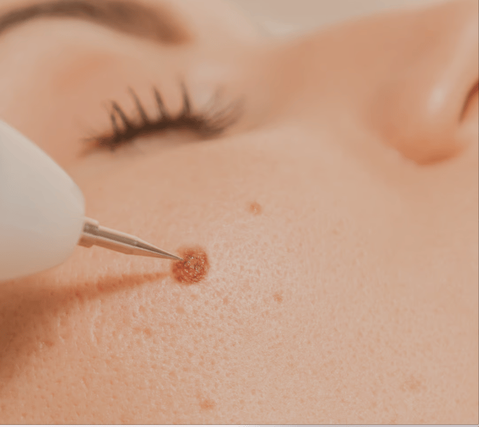 eliminación de lunares