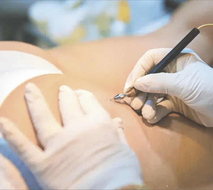 micropuntura de estrías y cicatrices