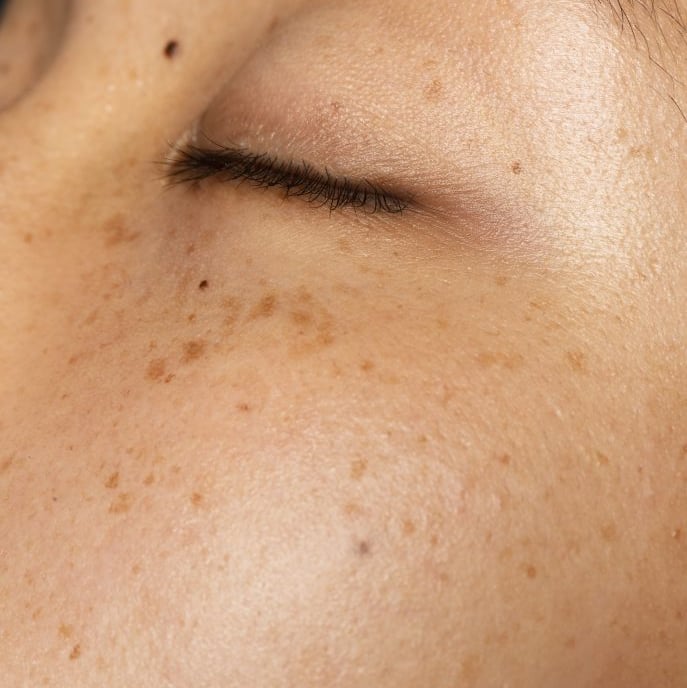 amabelle melasma