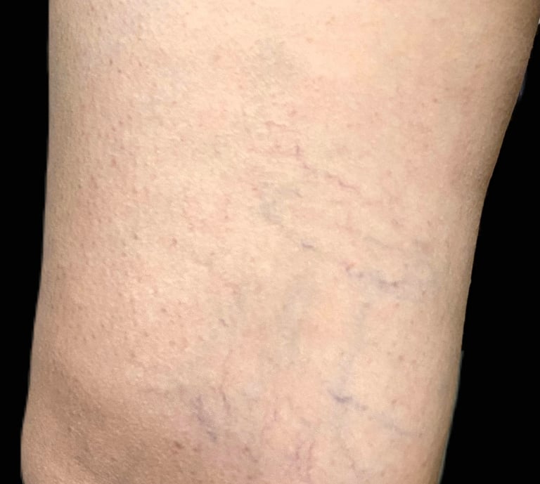 Telangiectasias treatment at Ariana Esthetic Edmonton.