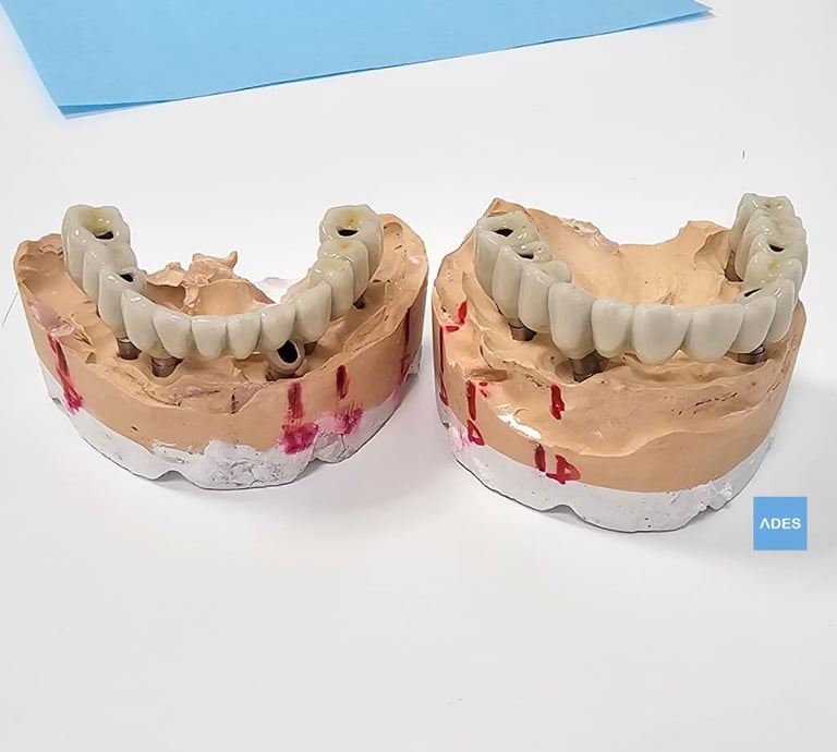 protesis sobre implantes