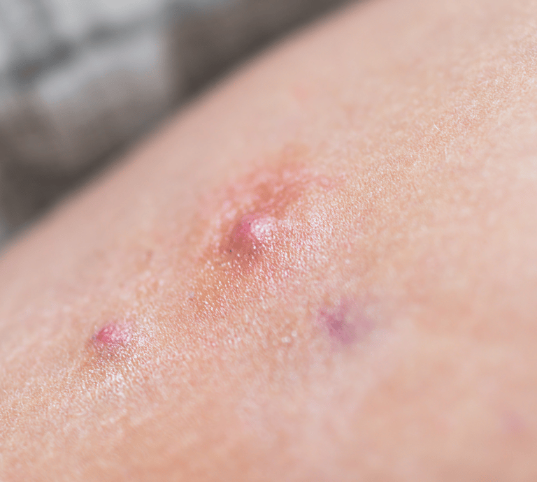 Hidradenitis Suppurativa