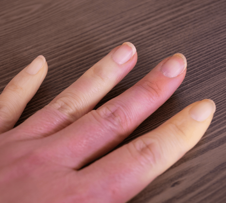 Finger Nail Discolouration