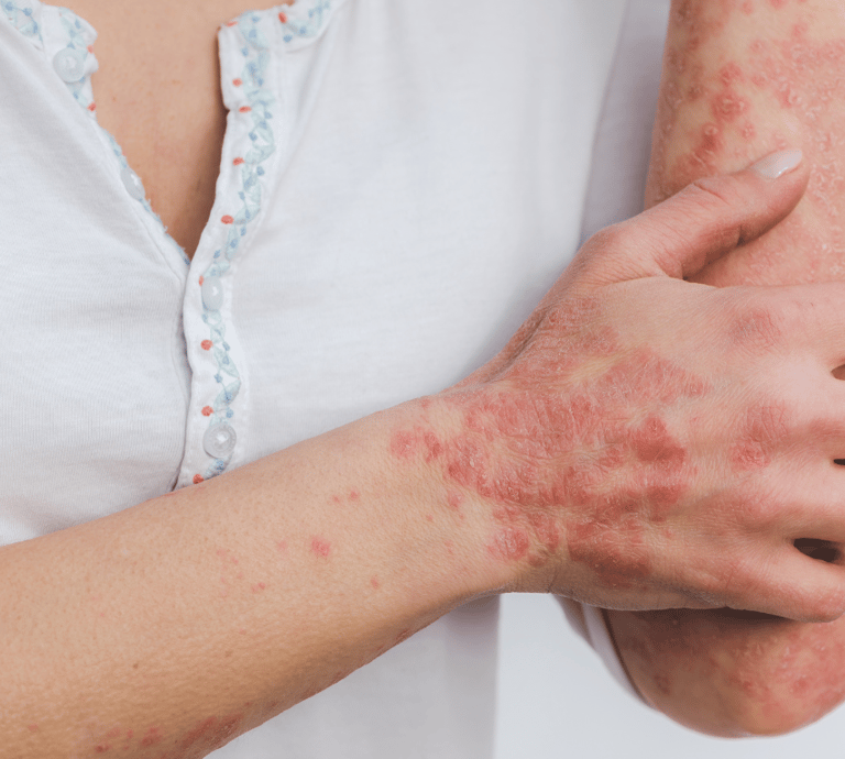 Psoriasis