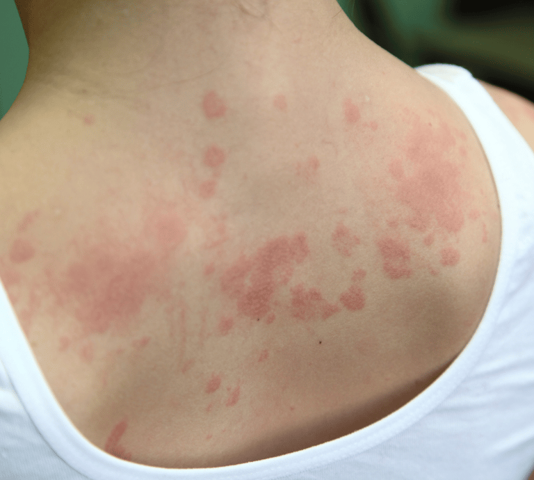 Urticaria