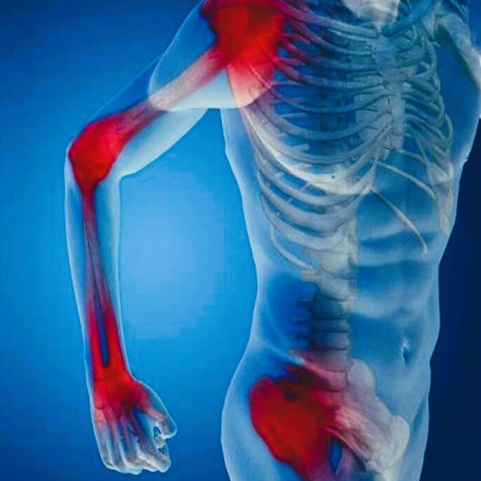 arthritis