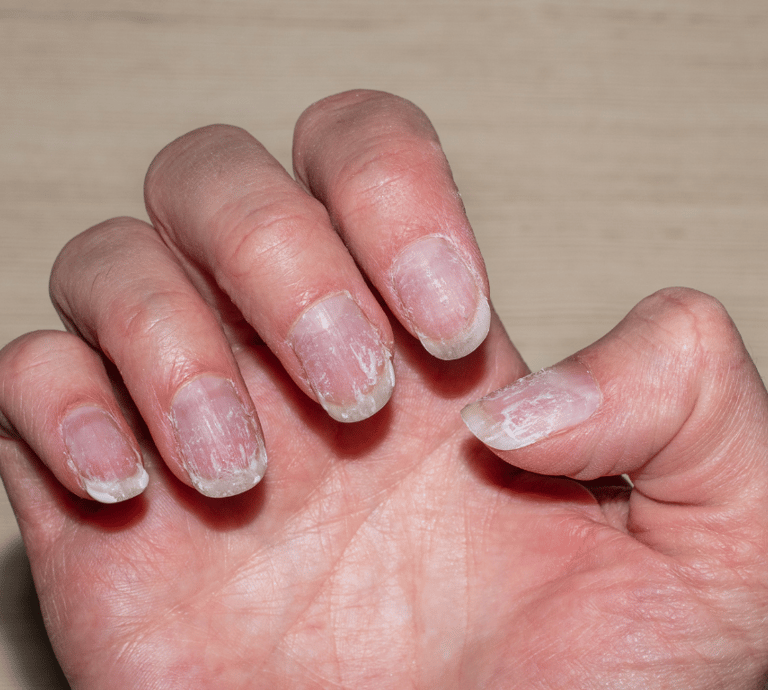 Brittle Nails