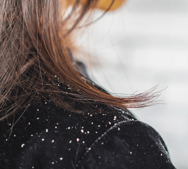 Dandruff