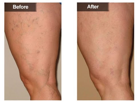 Varicose veins jordan