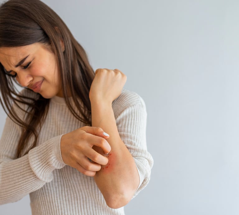 Eczema
